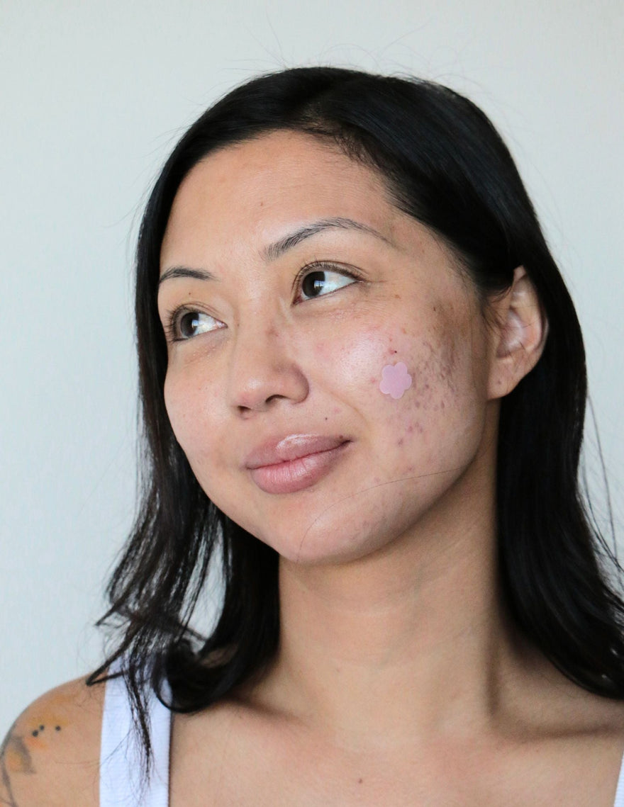 Acne Awareness Month: Your Skin Does Not Define Your Beauty